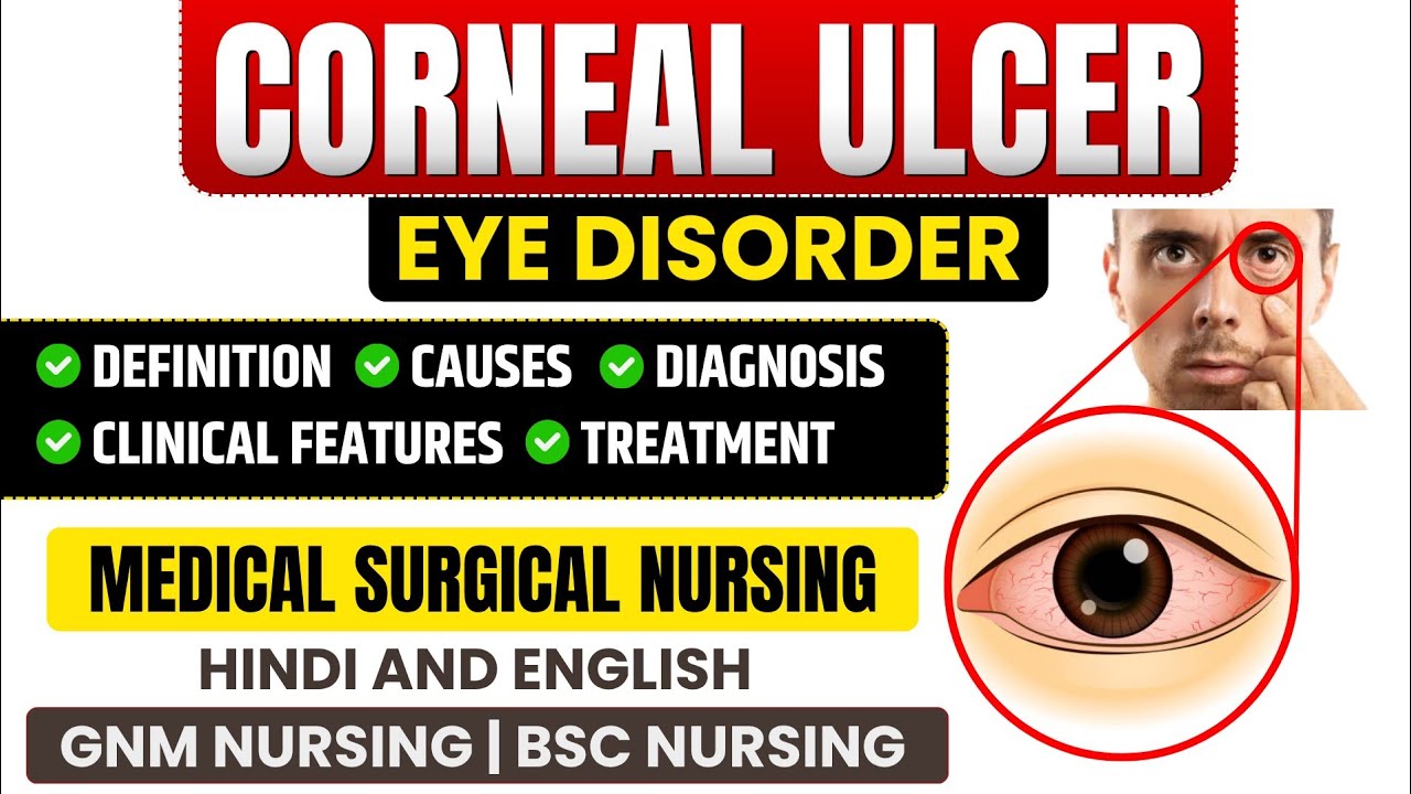 Corneal Ulcer Lecture | Causes, Symptoms, Treatment & Prevention // Corneal Ulcer In Hindi