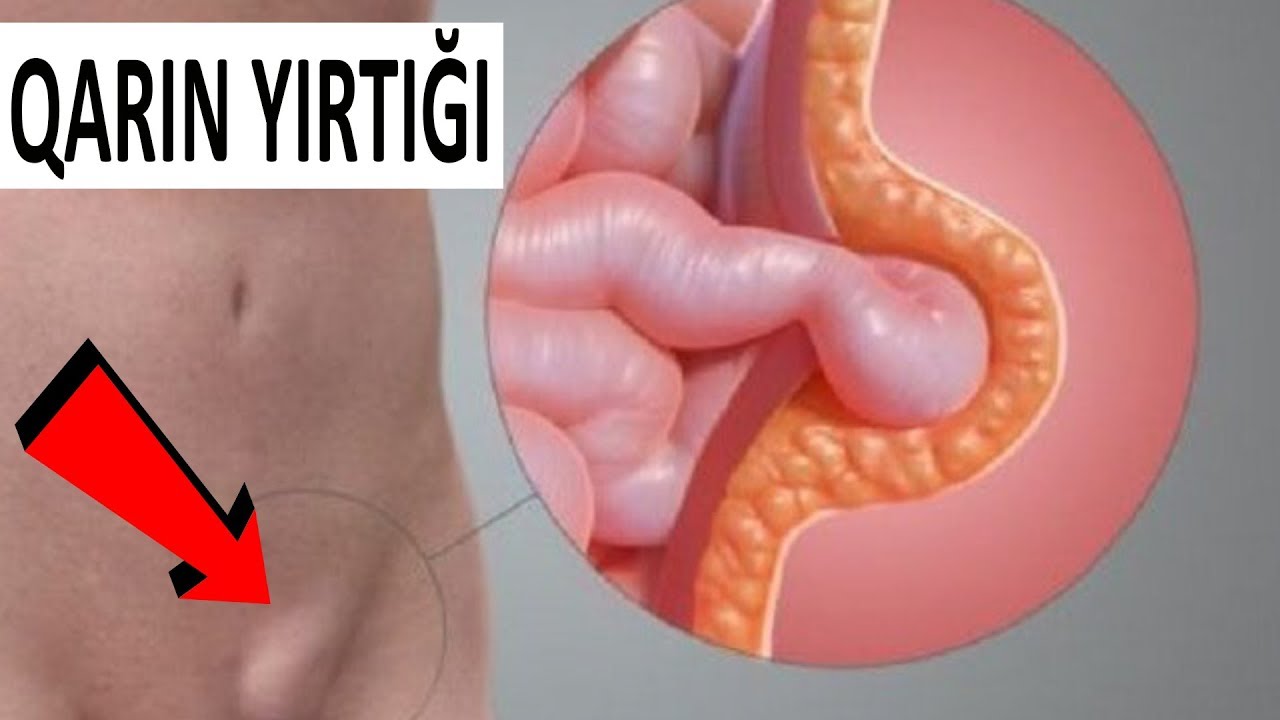 Qarın yırtığı nədir? - MÜALİCƏ ÜSULU