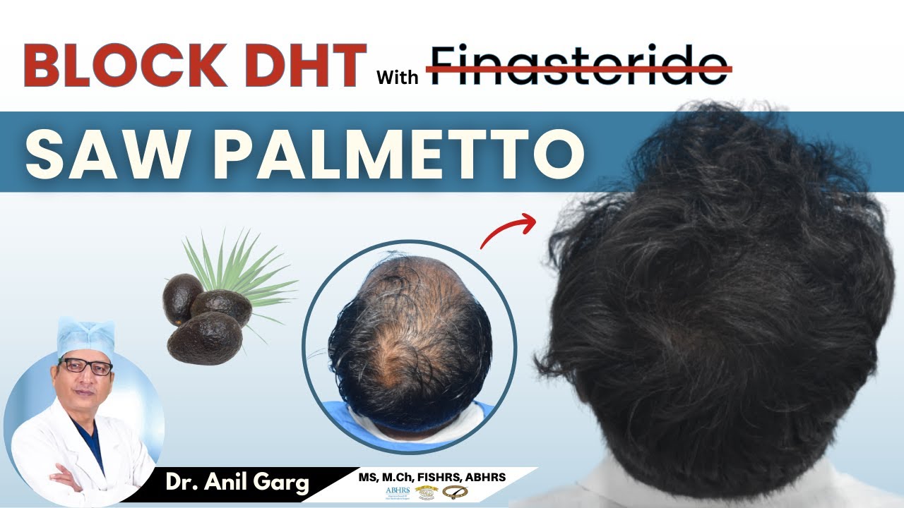 Saw Palmetto as Natural DHT blocker | Saw Palmetto के रहस्य Hair Loss | DHT और DHT Blocker क्या है?