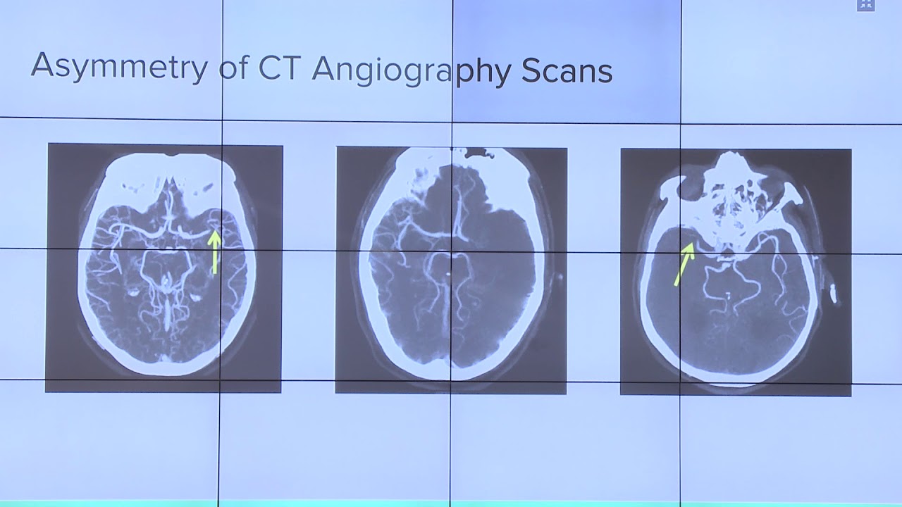 MIC 2018 - Deep Learning for ELVO Stroke Detection