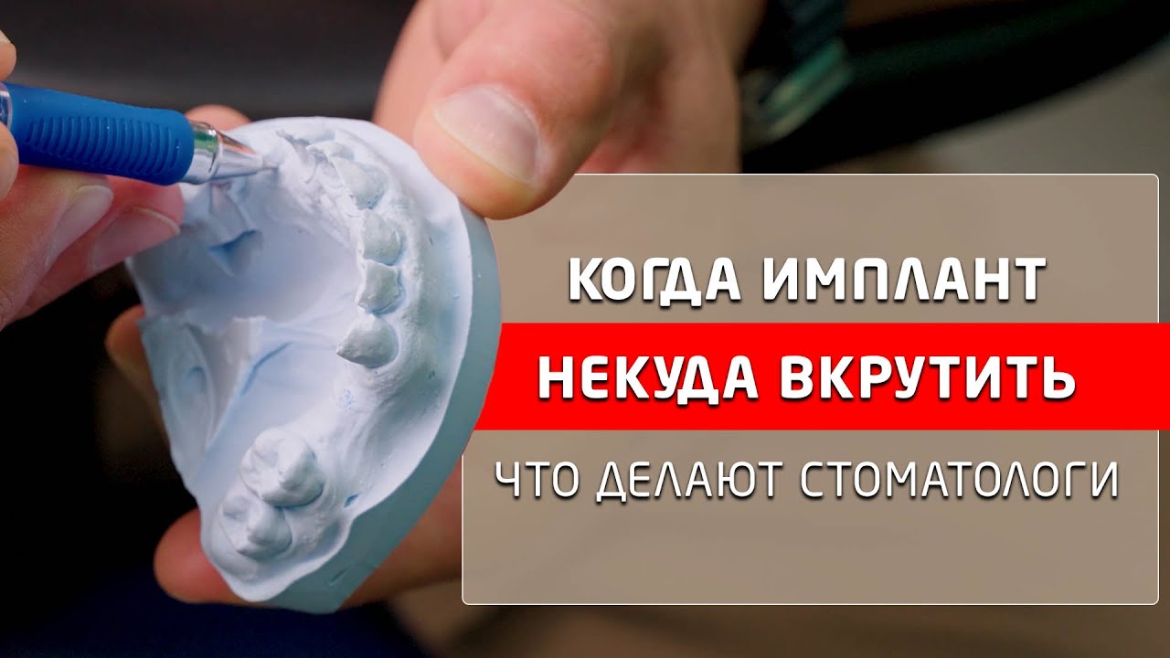 Костная пластика нижней челюсти и синус-лифтинг, зачем стоматологи делают это.
