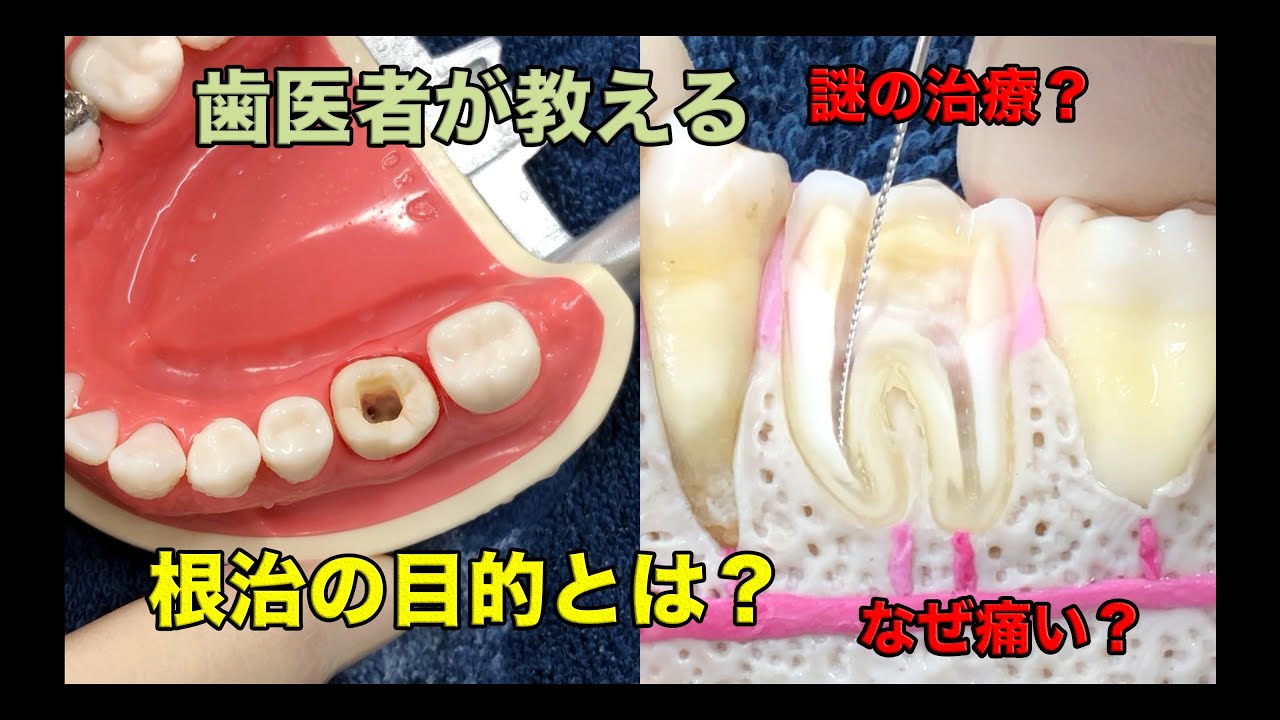 【横浜戸塚　内藤歯科】根治の説明動画② 根治の目的とは？