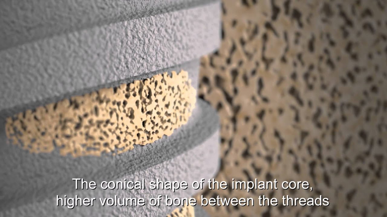 Adin Dental Implant Systems - Technology