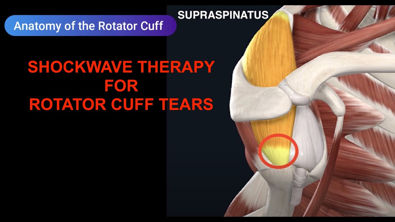 Shockwave therapy for rotator cuff tears,  torn supraspinatus, shoulder impingement & labrum tears