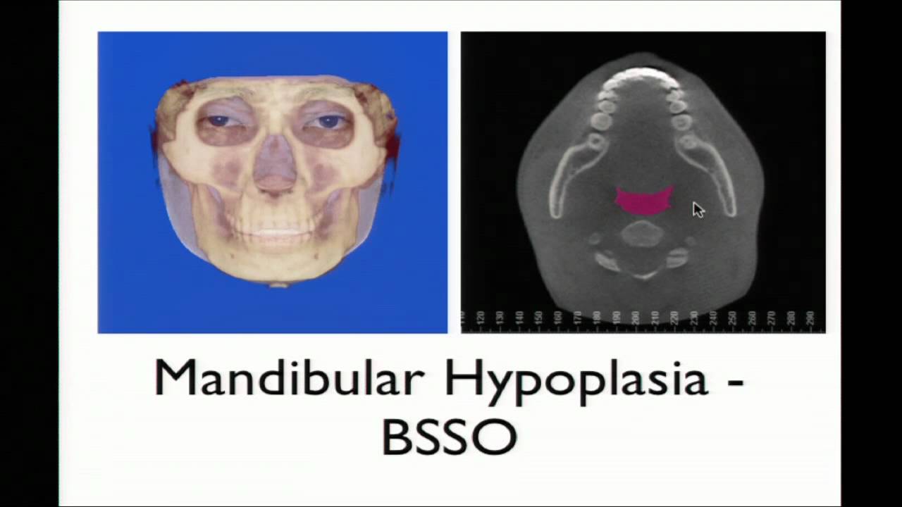 Stanford's Dr. Sabine Girod Discusses Minimally Invasive Aesthetic and Functional Jaw Surgery