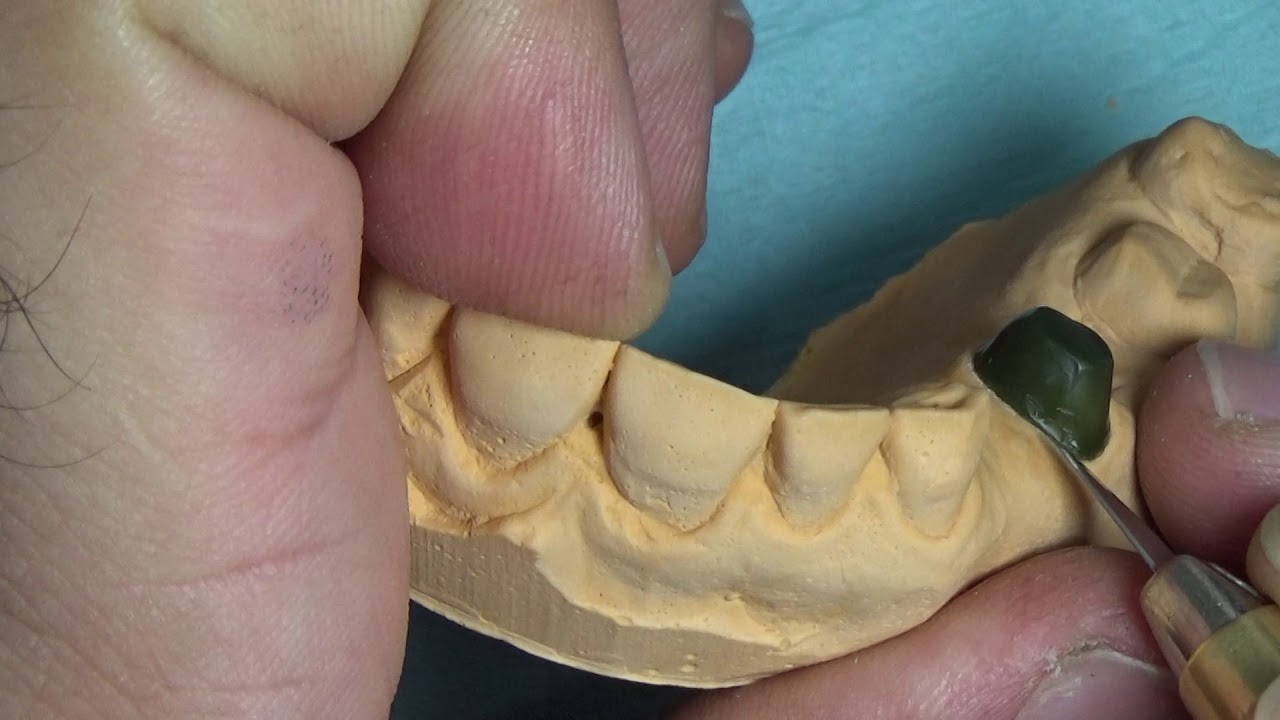 coping inlay wax ,crown & bridge جانب من دوره شمع ومعدن مبتدئين