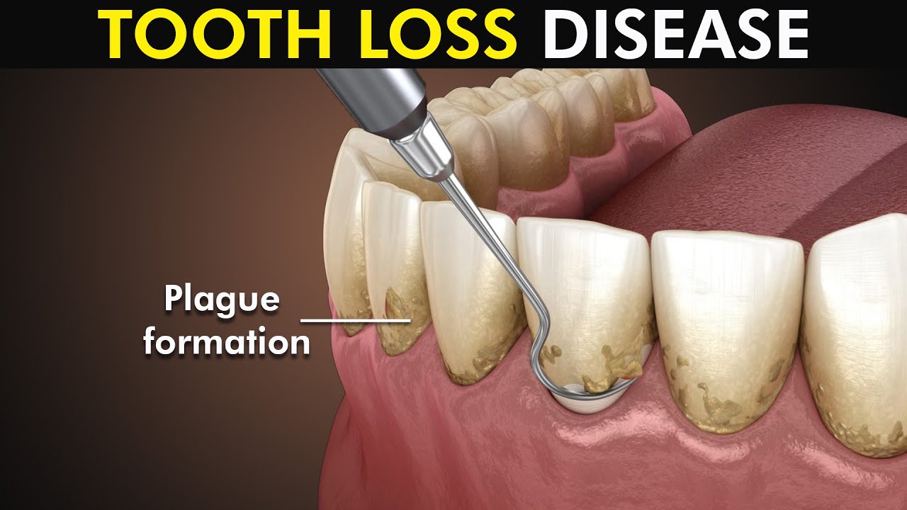 Periodontitis or Gum disease: 3d animation included