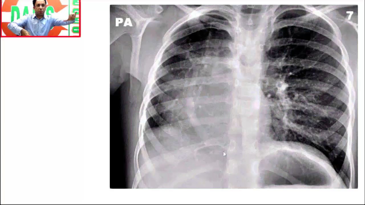 #DAMS #Medicine #Unplugged #Scimitar Sign CXR