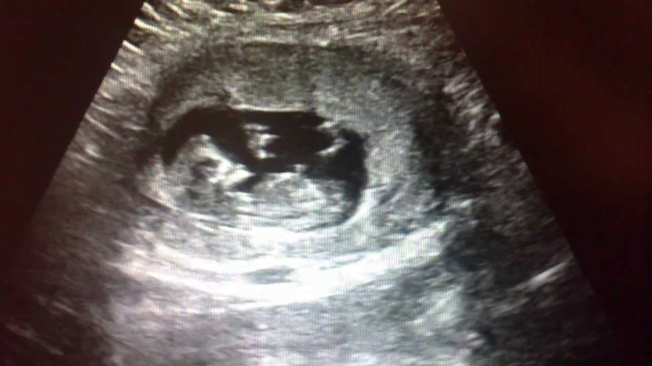 Ultraljud Tvillingar vecka 12 / Twins ultrasound 12 weeks