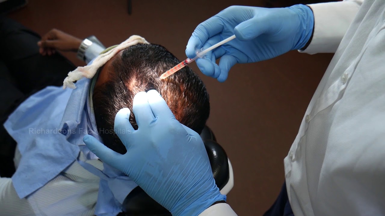 PRP Treatment - Platelet Rich Plasma for Hair Loss at Richardsons