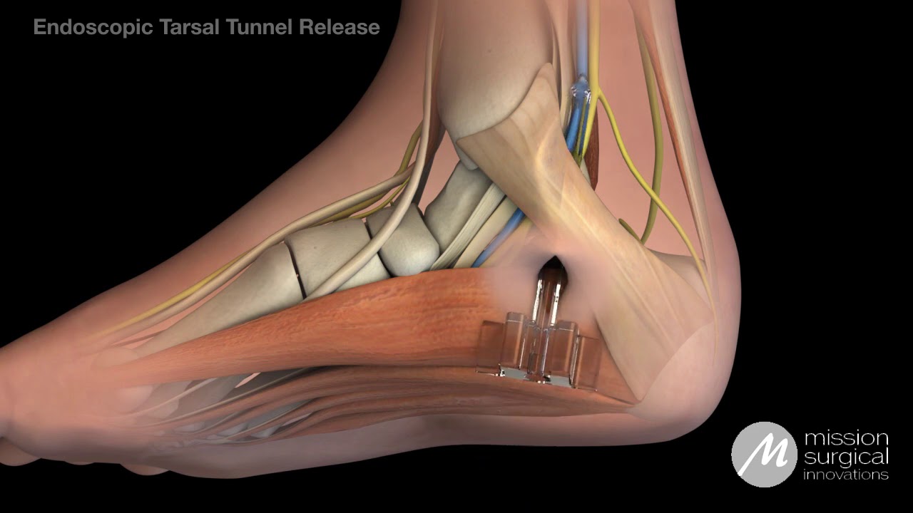 SafeView Animation Series: Endoscopic Tarsal Tunnel Release