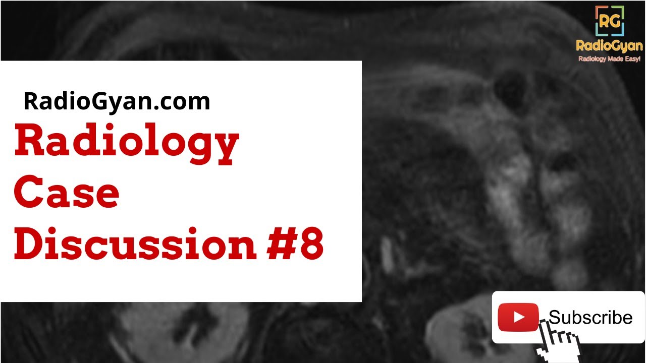 Choledochocele and Choledochal Cyst - Imaging approach (Case based)| Radiology Board Review Case