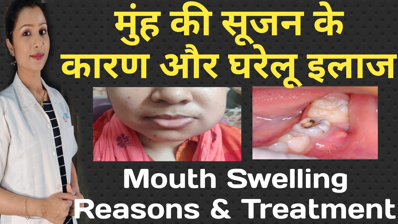 मुंह में सूजन के कारण और घरेलू इलाज |Mouth Swelling Reasons And Treatment | Face Swelling HomeRemedy