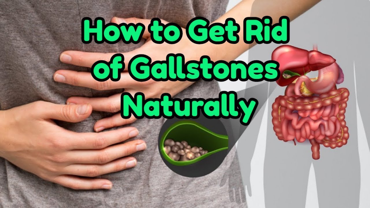 How to Get Rid of Gallstones Naturally - Stop Gallbladder Pain!