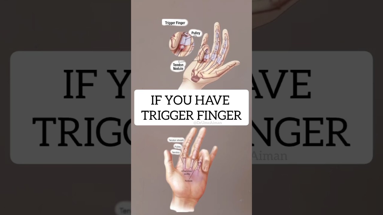 If you have Trigger Finger, try these two exercises #triggerfinger