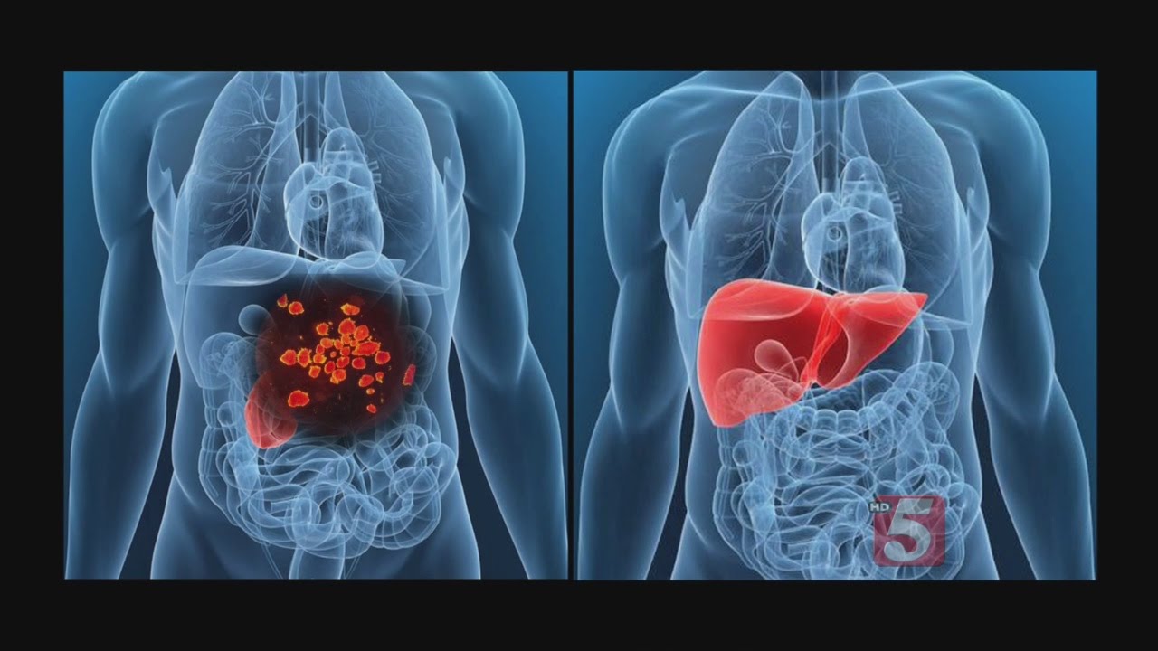 Islet Cell Transplantation Helping With Type I Diabetes