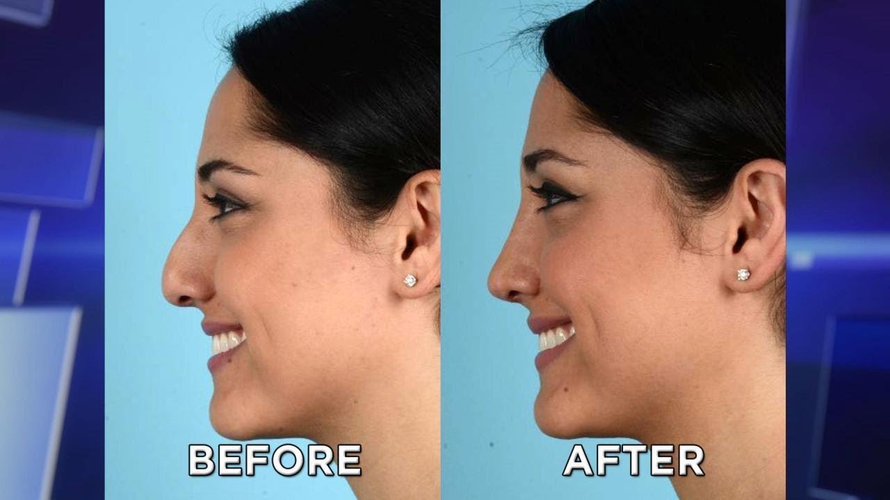 Woman’s Life Changed after Amazing Septum Reconstruction Surgery