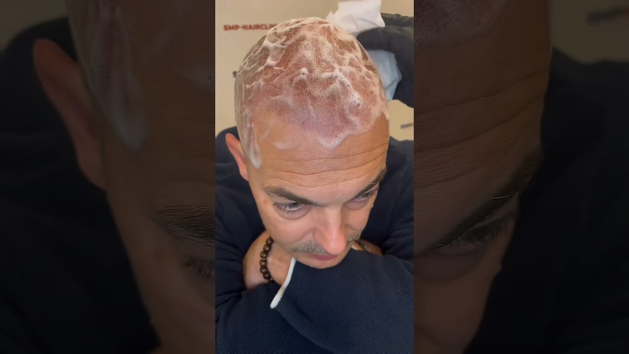 Effet ras&eacute; session 1 en micropigmentation capillaire #dermopigmentation #tricopigmentation #cheveux