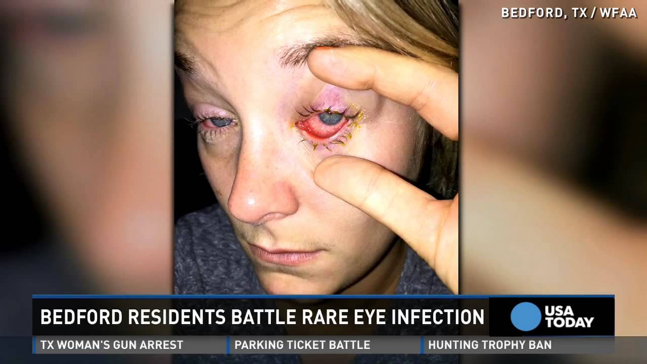 Rare eye parasite causes sharp pain in those infected