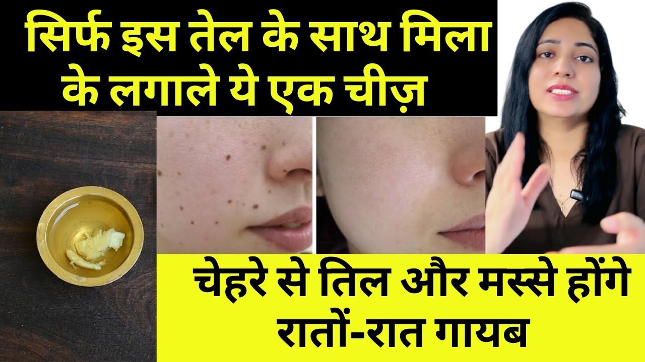 तिल और मस्से को जड़ से खत्म करने घरेलु उपाय | Home remedies to remove moles and warts |