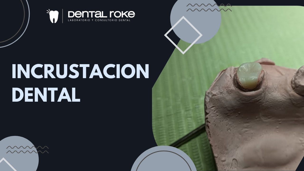 Haciendo una incrustación 🦷 