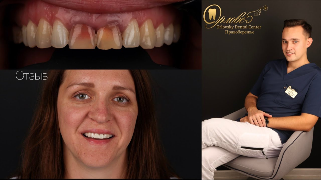 🤗 Отзыв Ольги о преображении улыбки в стоматологии Orlovsky Dental Center Правобережье/г.Калуга