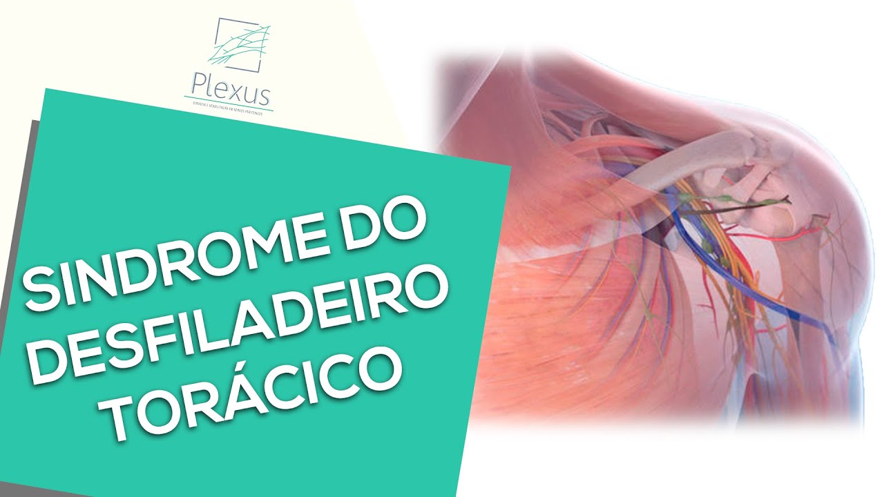 Síndrome do Desfiladeiro Torácico