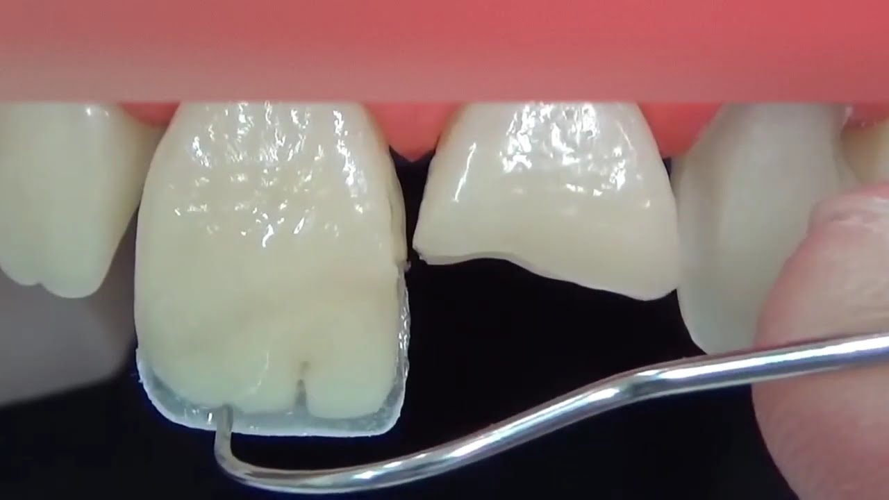 Direct restoration of a front tooth in just 3 minutes