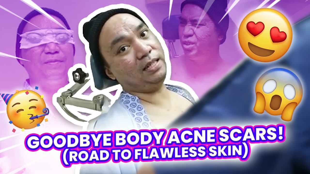 GOODBYE BODY ACNE SCARS (ROAD TO FLAWLESS SKIN) | CHAD KINIS VLOGS