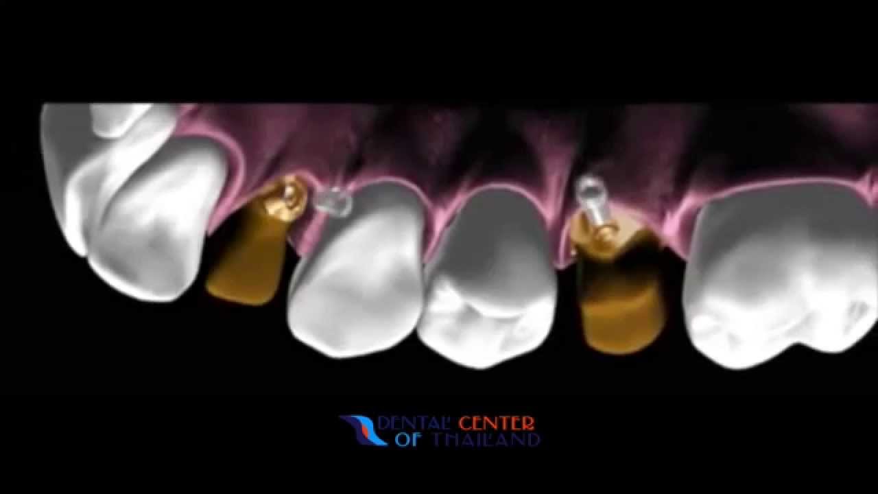 Affordable All on 4 Dental Implants in Bangkok Thailand The Clear Choice for Cosmetic Dentistry