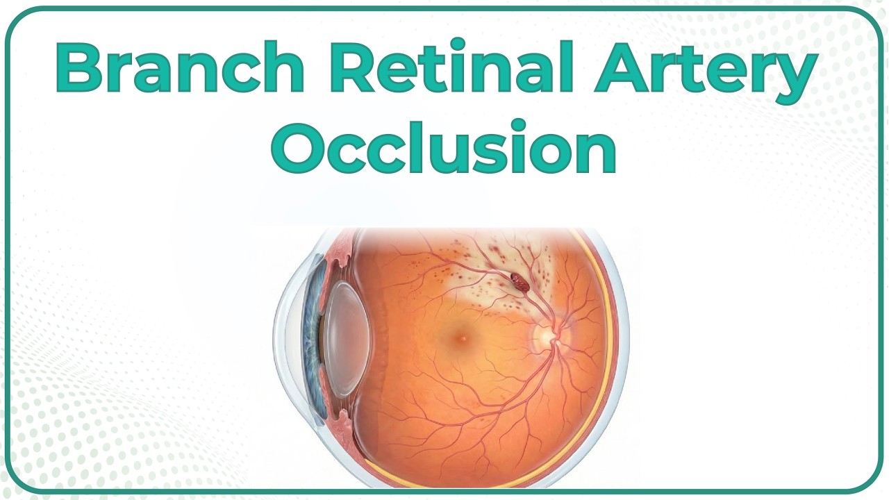Branch Retinal Artery Occlusion (BRAO) 👁️  Internal Medicine Ophthalmology | USMLE Step 2 CK