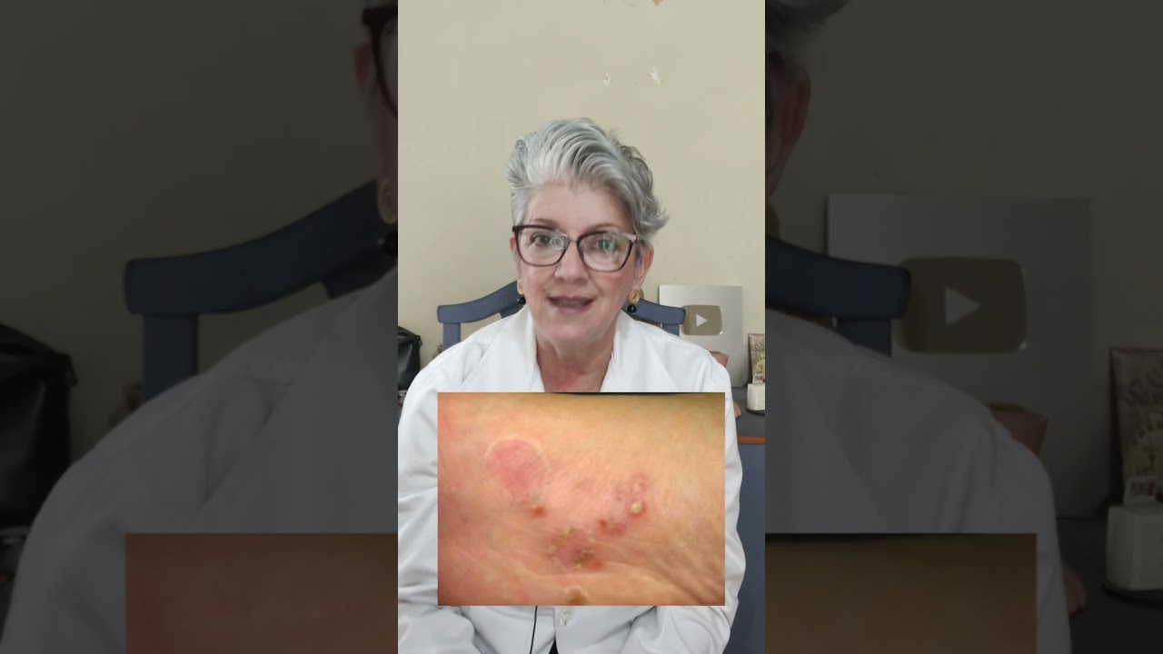 DISIDROSE ou MICOSE? Saiba a diferença 