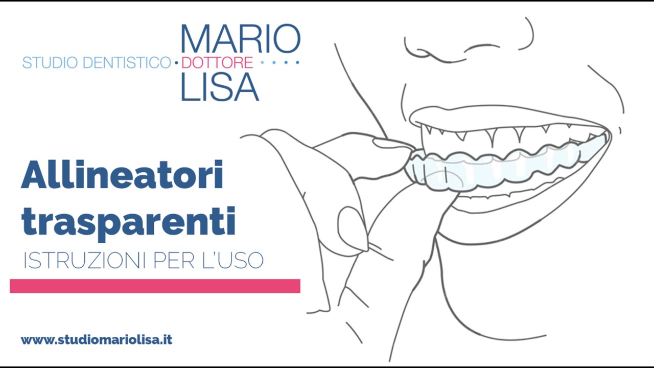 ALLINEATORI TRASPARENTI | Tutto Quello Che Devi Sapere | STUDIO MARIO LISA