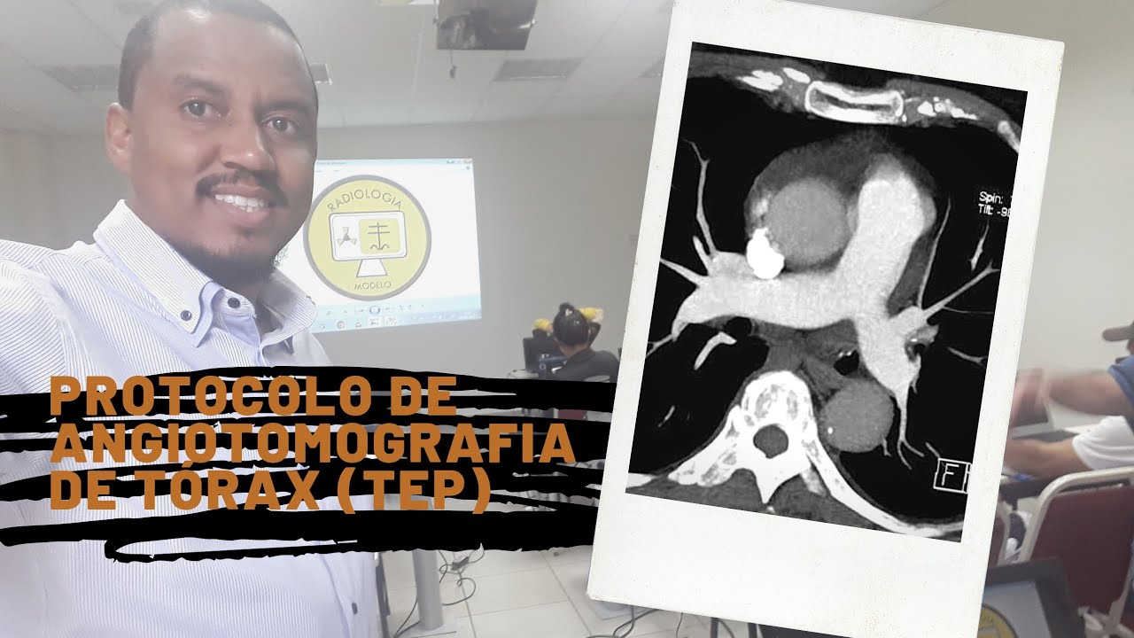 ANGIOTOMOGRAFIA DE TORAX (TEP) - DIEGO CESAR