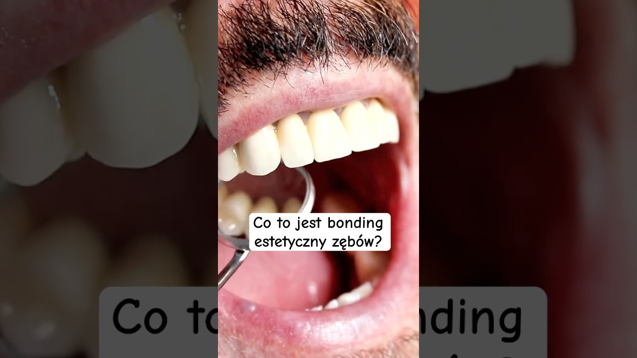 Co to jest bonding estetyczny zęb&oacute;w?