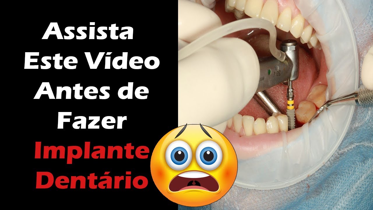 Implante dentário – Conheça os 5 MAIORES RISCOS E COMPLICAÇÕES Deste Tratamento