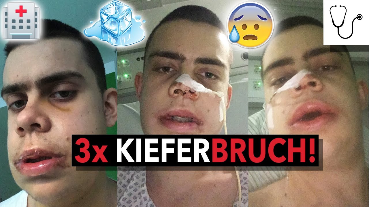 Meine BIMAX OP! Der GANZE VERLAUF! OP Tag - 8 Monate nach OP | double jaw surgery | Kiefer OP