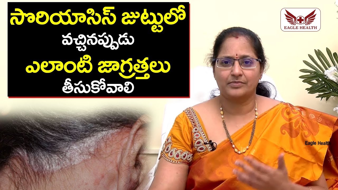How to cure scalp psoriasis | Psoriasis treatment | Psoriasis cure | Guttate psoriasis | psoriasis