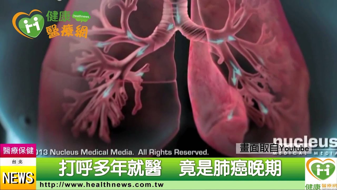 打呼多年就醫　竟是肺癌晚期