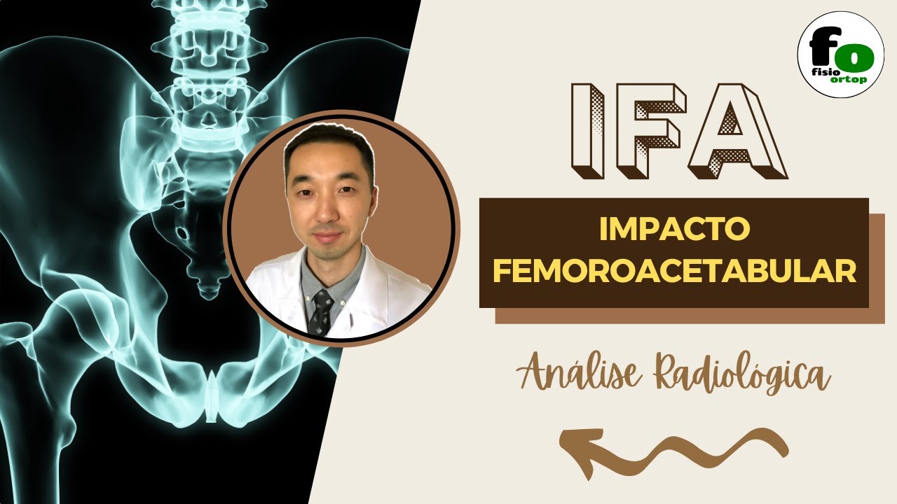 Impacto FemoroAcetabular (IFA): avaliação radiológica