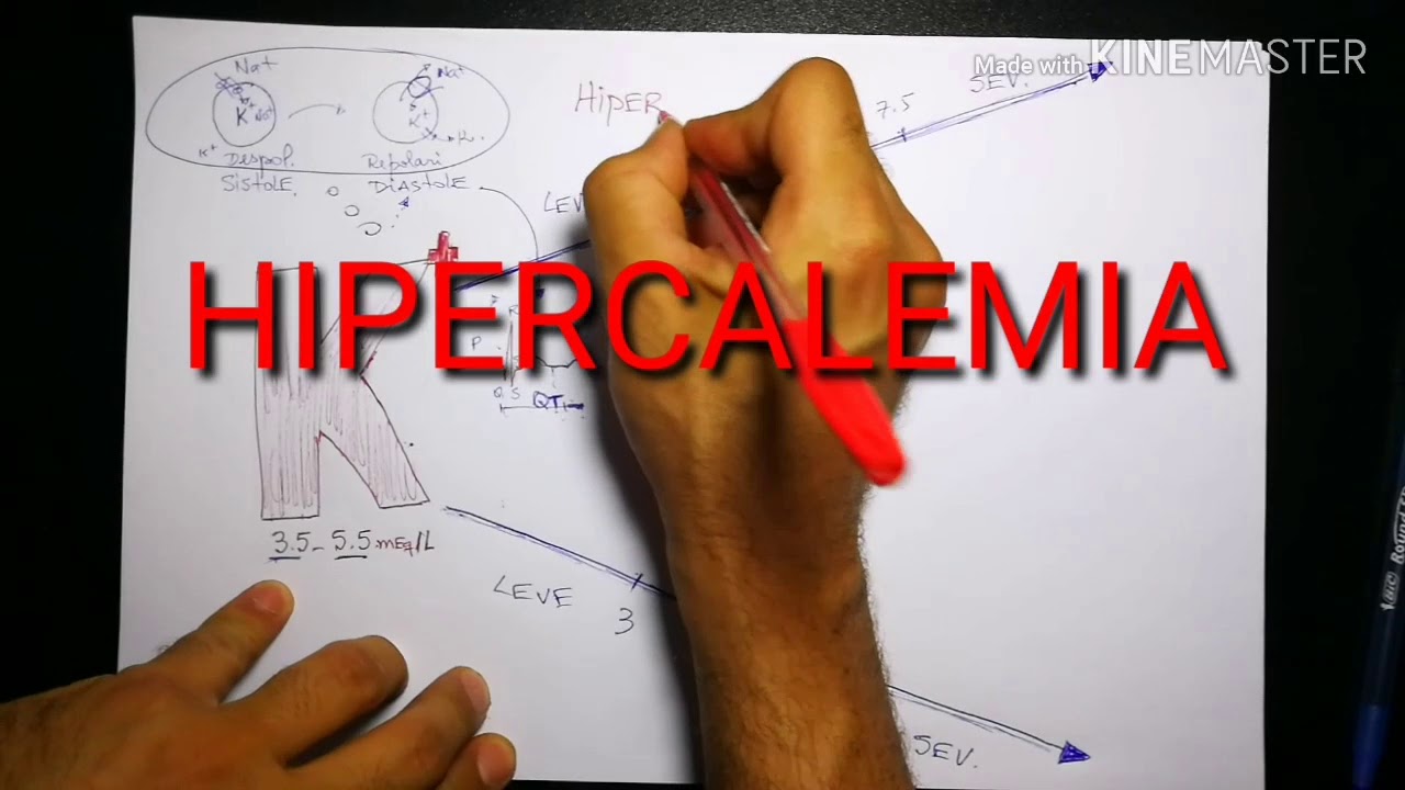 ECG / HIPOCALEMIA /HIPERCALEMIA