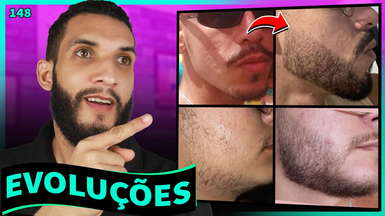 RESULTADOS COM MINOXIDIL (evolução dos inscritos) #148