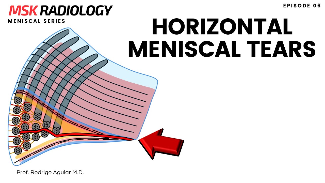 Horizontal Meniscal Tear on MRI
