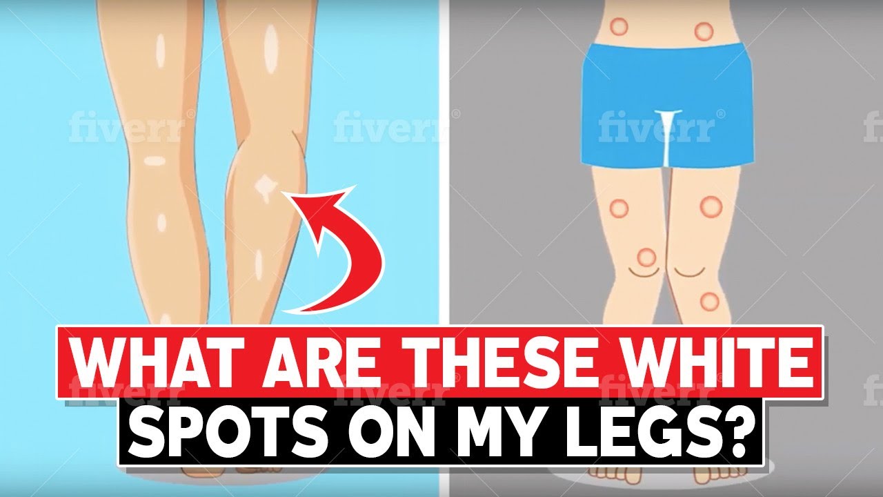 What Are These White Spots On My Legs?