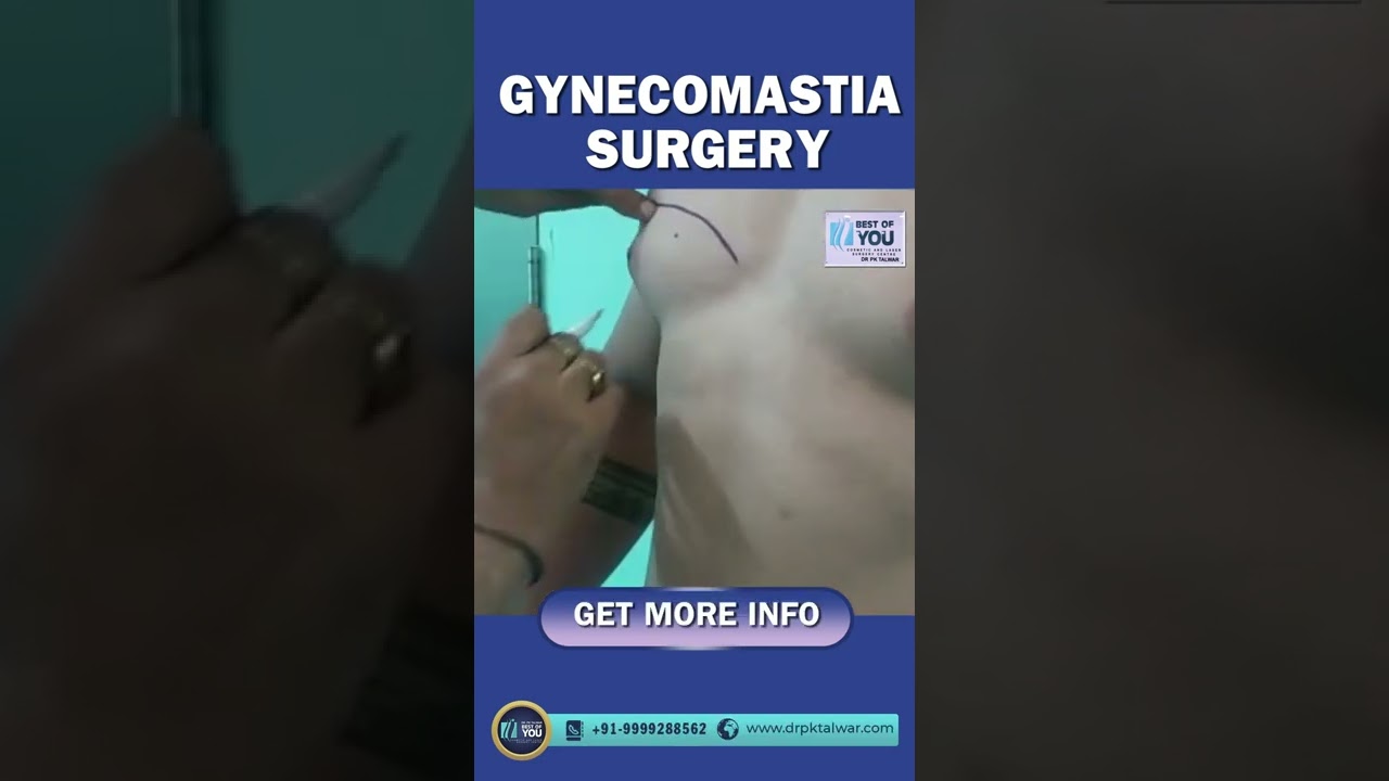Preoperative Marking in Gynecomastia Surgery, Male Breast Reduction Surgery in Delhi, Dr. PK Talwar