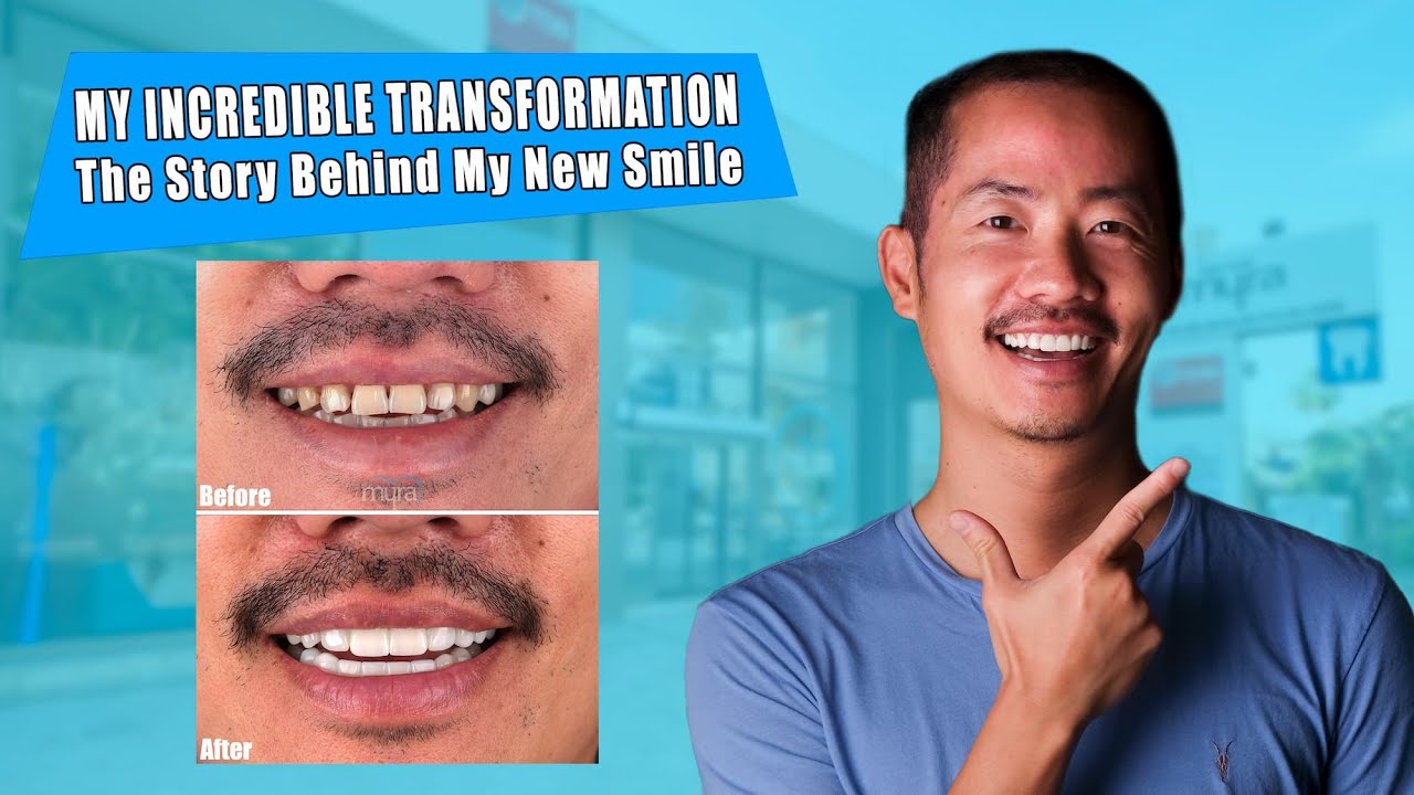Incredible Transformation: My New Smile with 3 Implants & 21 Zirconia Crowns! | Patient Story