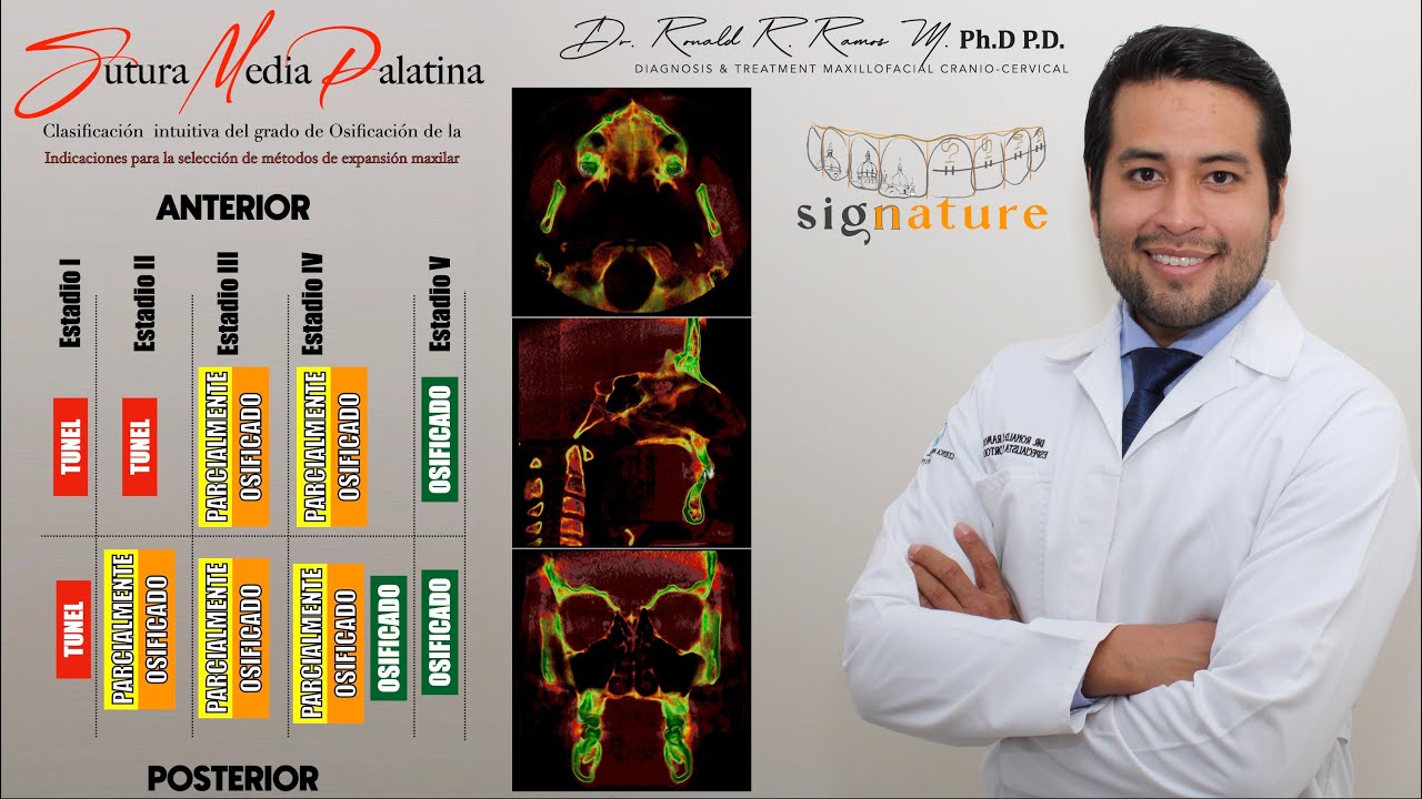 Clasificación de la OSIFICACIÓN de la SUTURA PALATINA MEDIA basado en pseudocolores y multicapas.