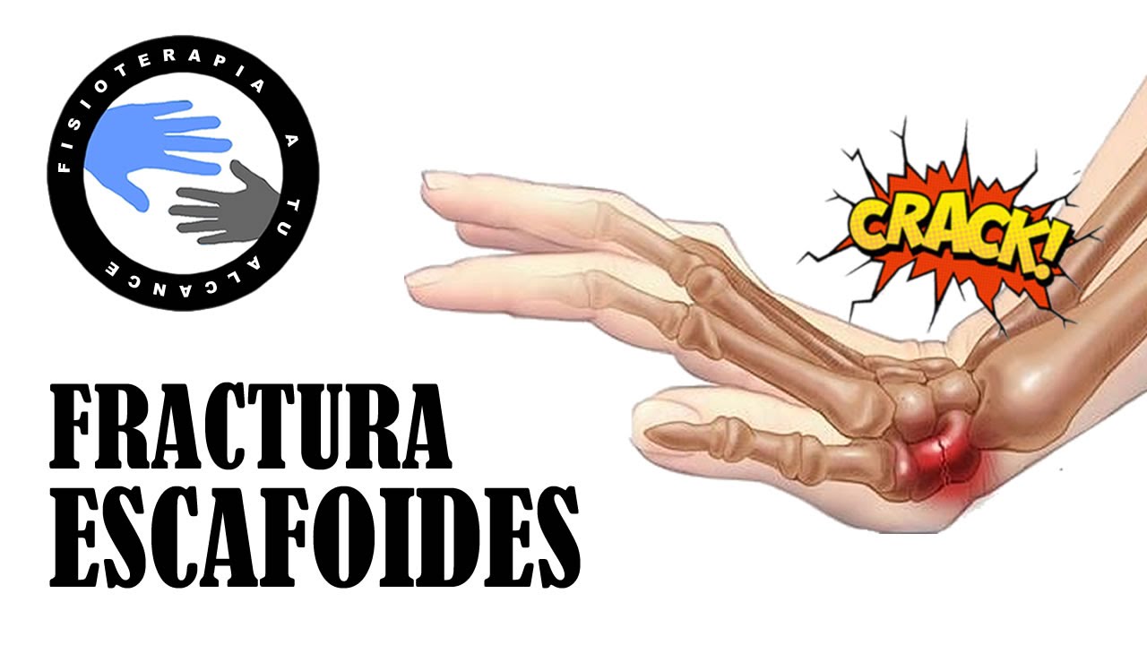 Fractura de escafoides mano, por que es importante reconocerla rapidamente