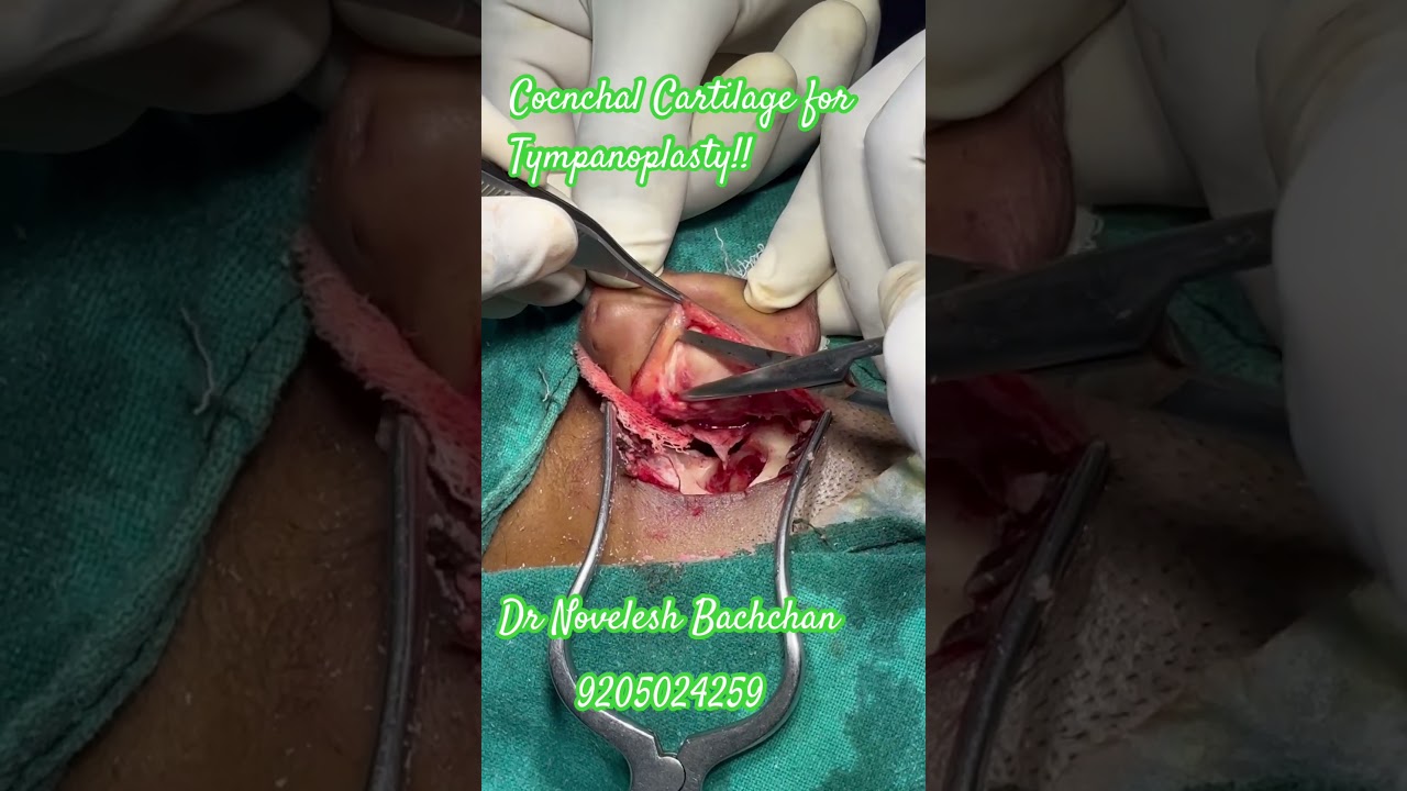 #Cartilage #eardoctor #entdoctor Tympanoplasty #Conchal #Cartilage
