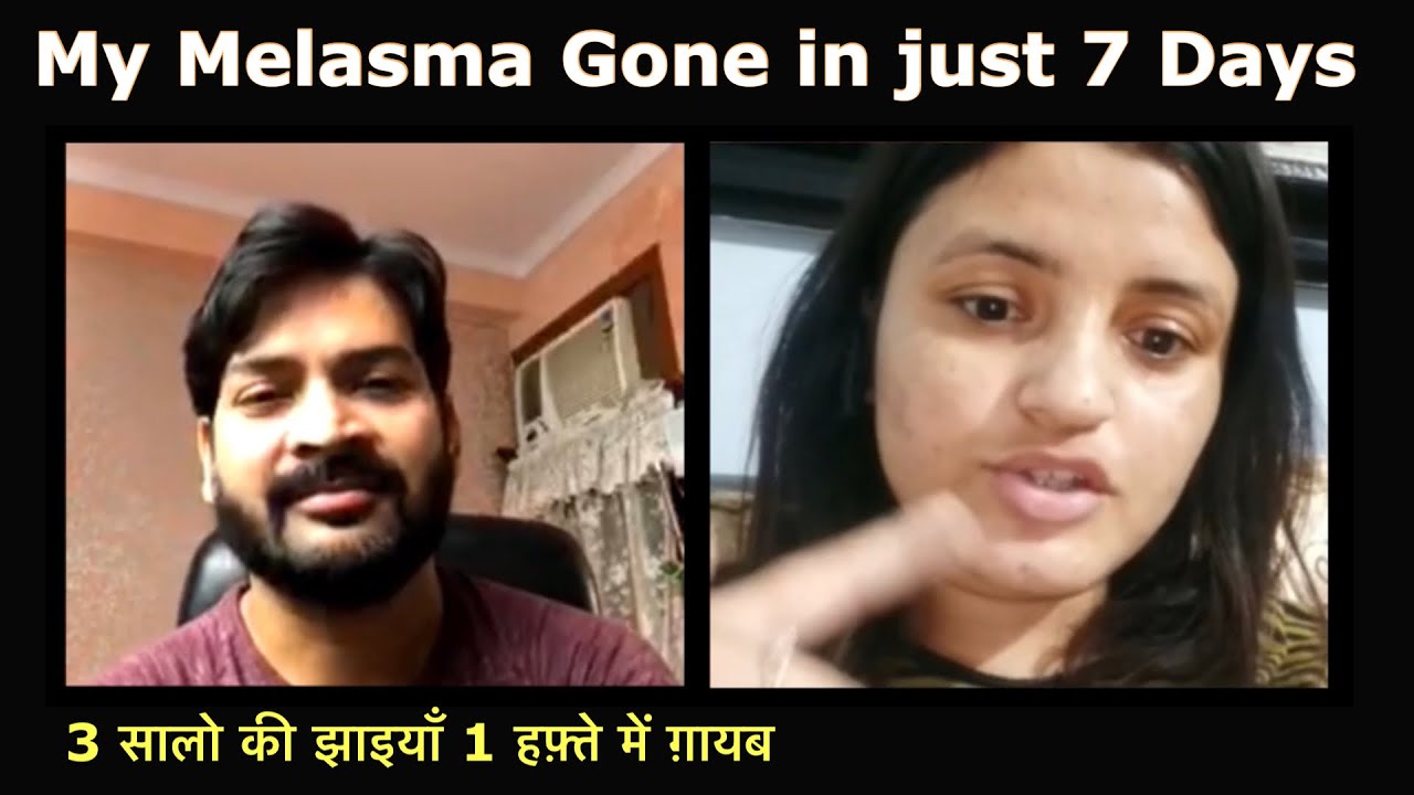 My Melasma/Pigmentation gone in just 7 Days. #HealthySyrusDiet